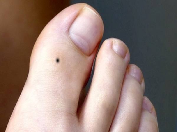 Nốt ruồi ở ngón chân cái có ý nghĩa gì, tốt hay xấu